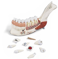 MOD: Unterkieferhälfte mit 8 kariösen Zähnen, 19-teilig